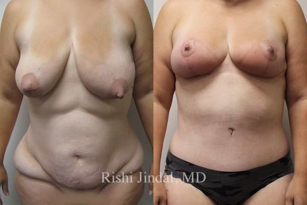 Before and after photos by Dr. Jindal, East County Coastal Plastic Surgeons