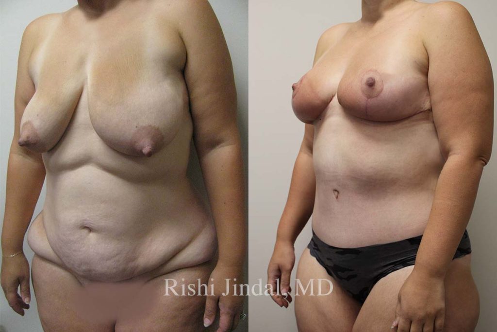 Before and after photos by Dr. Jindal, East County Coastal Plastic Surgeons