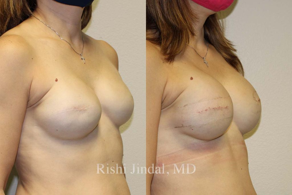 Before and after photos by Dr. Jindal, East County Coastal Plastic Surgeons