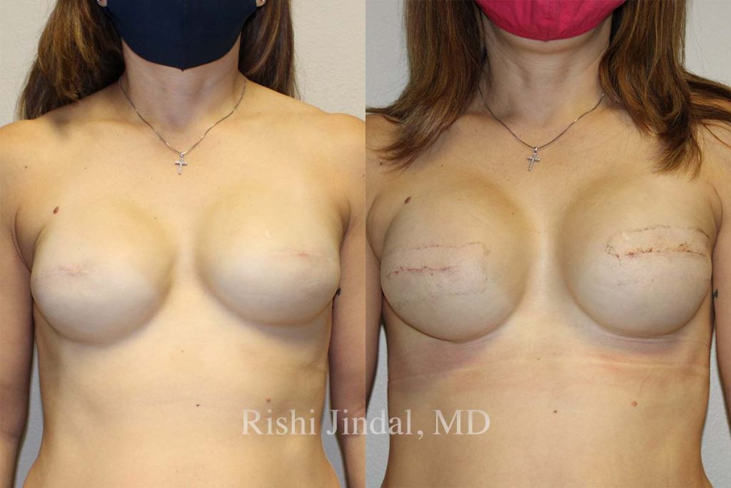 Before and after photos by Dr. Jindal, East County Coastal Plastic Surgeons