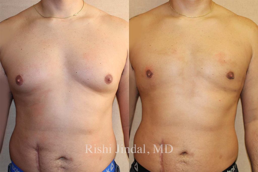 Before and after photos by Dr. Jindal, East County Coastal Plastic Surgeons