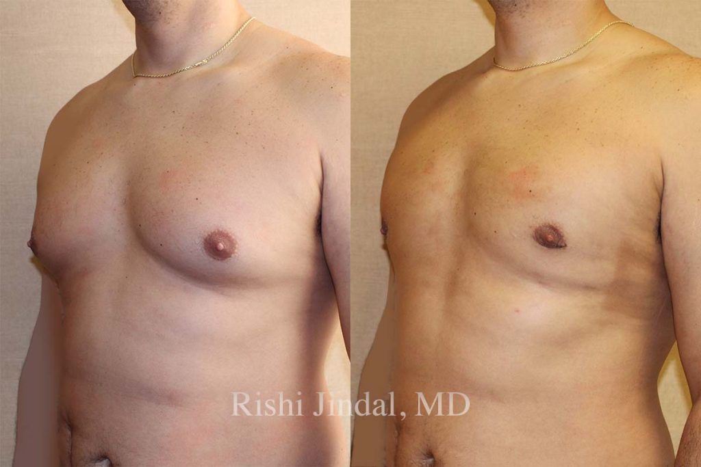 Before and after photos by Dr. Jindal, East County Coastal Plastic Surgeons