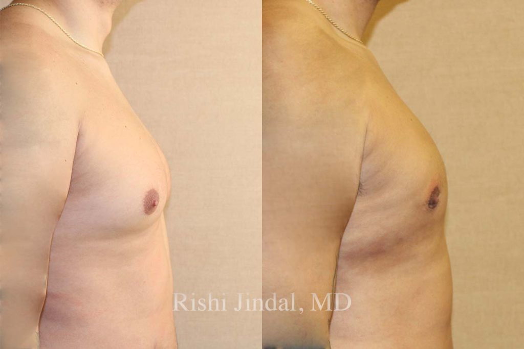Before and after photos by Dr. Jindal, East County Coastal Plastic Surgeons