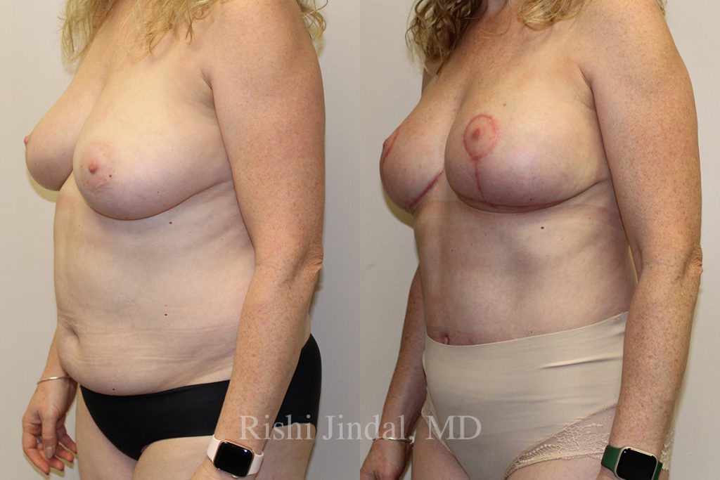 51487a Before and after photos by Dr. Jindal, East County Coastal Plastic Surgeons