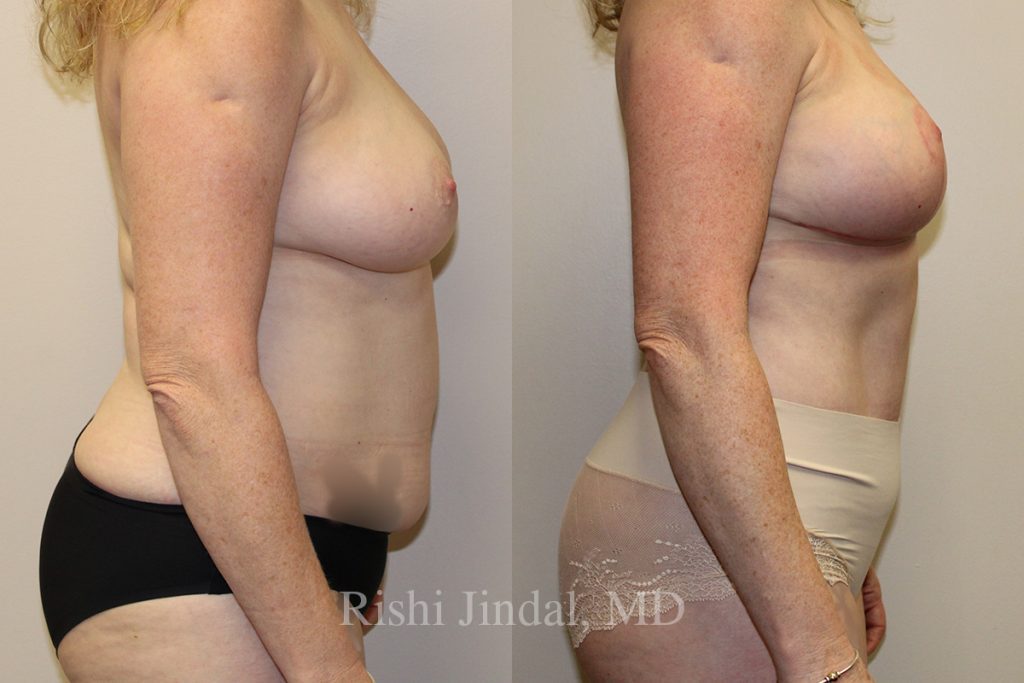 51487b Before and after photos by Dr. Jindal, East County Coastal Plastic Surgeons
