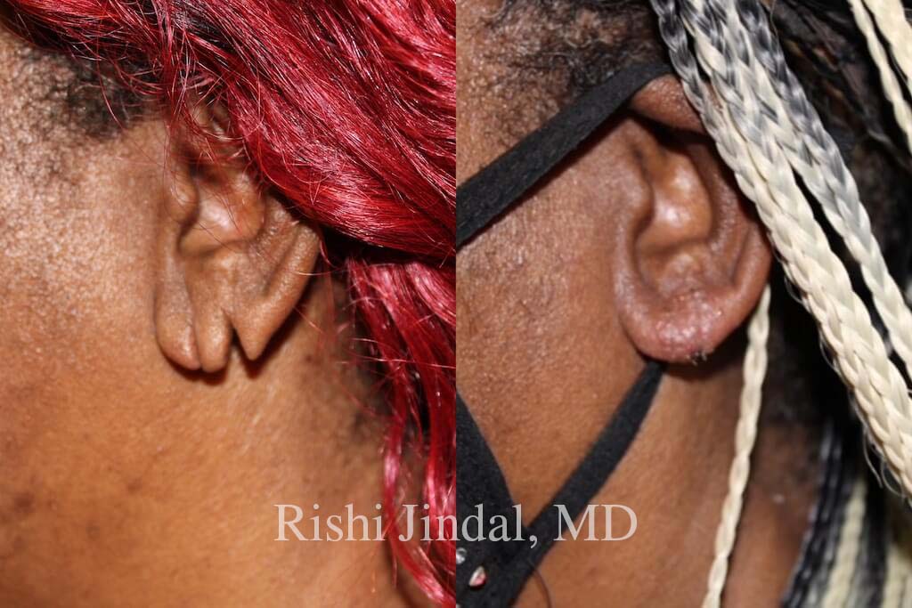 earlobe-p-01a Before and after photos by Dr. Jindal, East County Coastal Plastic Surgeons