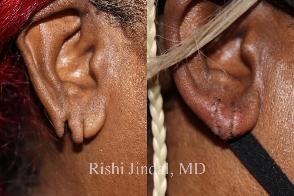 earlobe-p-01b Before and after photos by Dr. Jindal, East County Coastal Plastic Surgeons