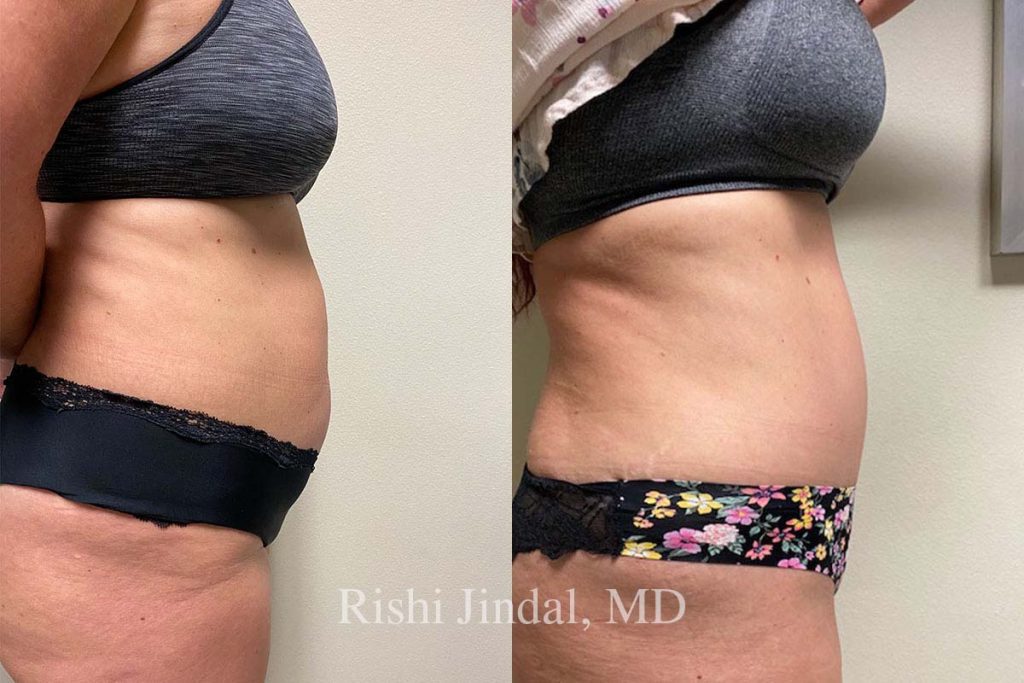 patient-47566a Before and after photos by Dr. Jindal, East County Coastal Plastic Surgeons