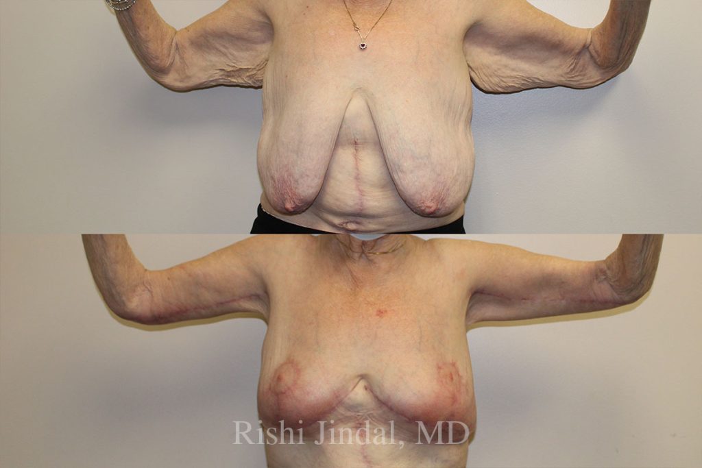 patient-500008b Before and after photos by Dr. Jindal, East County Coastal Plastic Surgeons