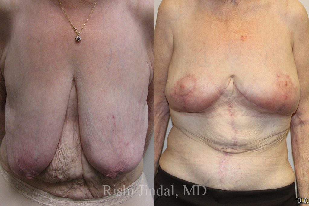 patient-50008-bl Before and after photos by Dr. Jindal, East County Coastal Plastic Surgeons