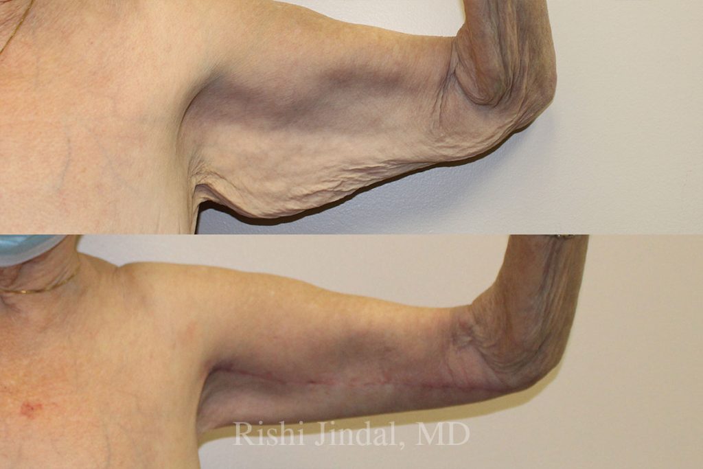 patient-50008a Before and after photos by Dr. Jindal, East County Coastal Plastic Surgeons