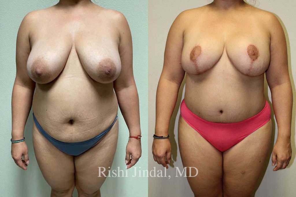 patient-50312a Before and after photos by Dr. Jindal, East County Coastal Plastic Surgeons