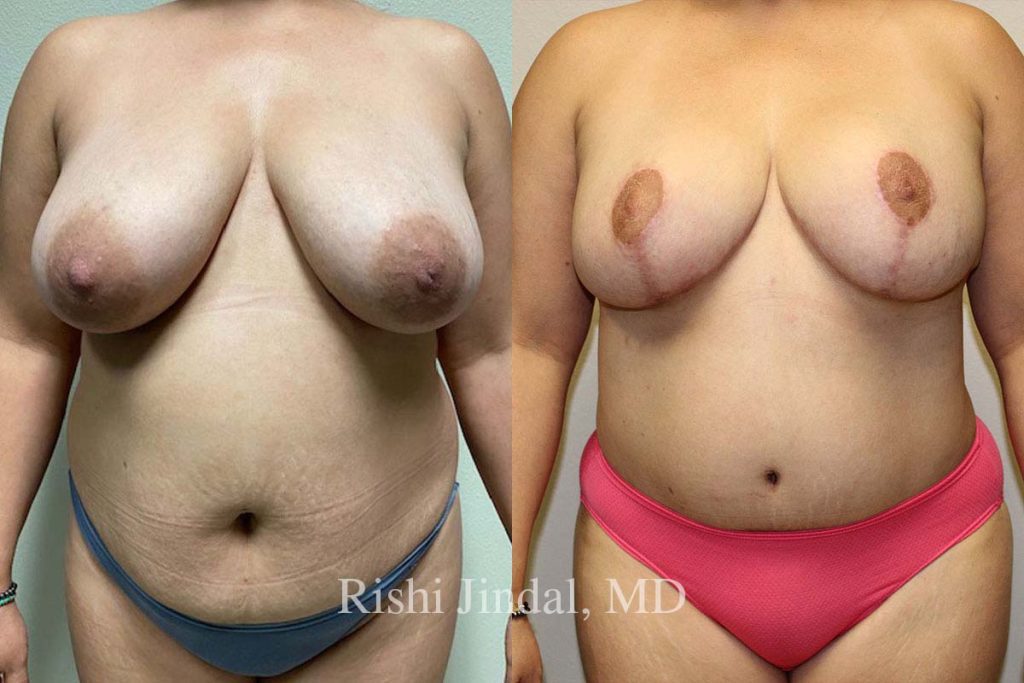 patient-50312b Before and after photos by Dr. Jindal, East County Coastal Plastic Surgeons