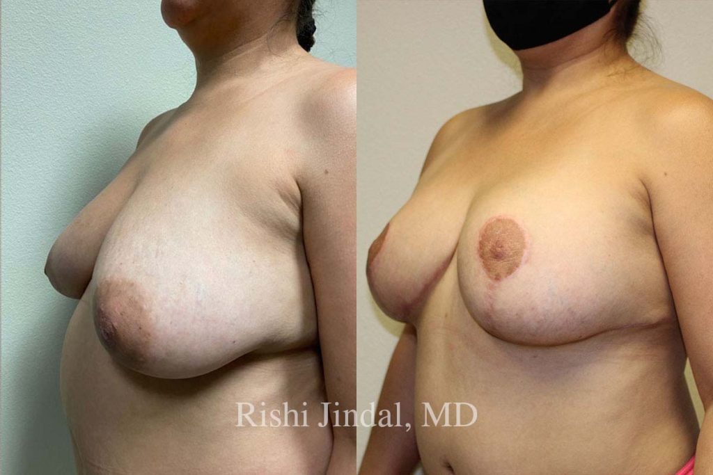 patient-50312c Before and after photos by Dr. Jindal, East County Coastal Plastic Surgeons