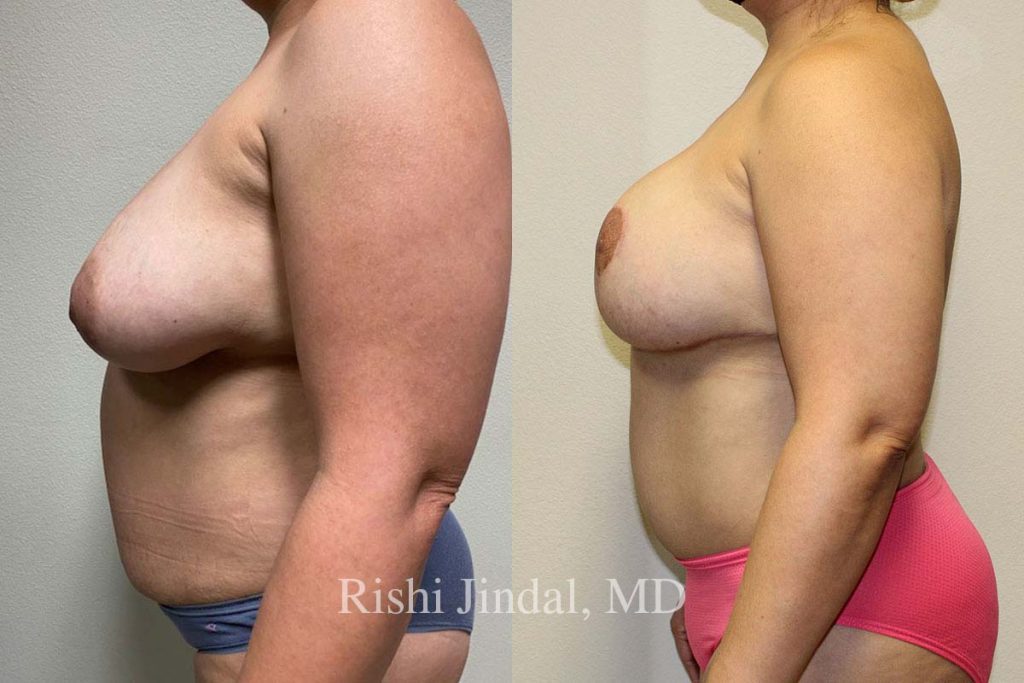 patient-50312e Before and after photos by Dr. Jindal, East County Coastal Plastic Surgeons