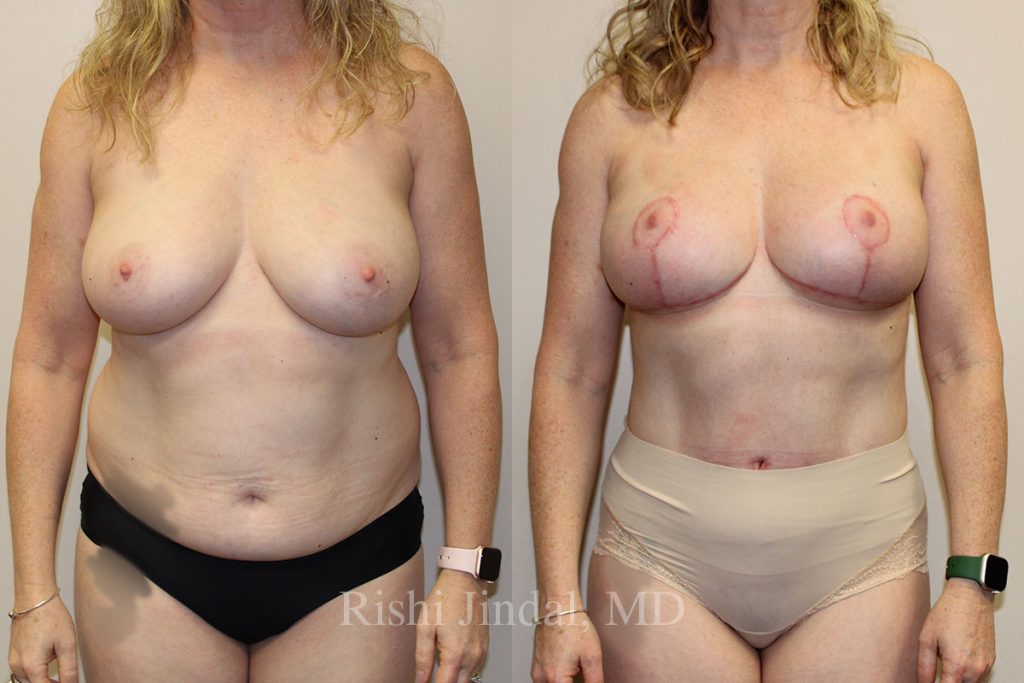 patient-51487c Before and after photos by Dr. Jindal, East County Coastal Plastic Surgeons