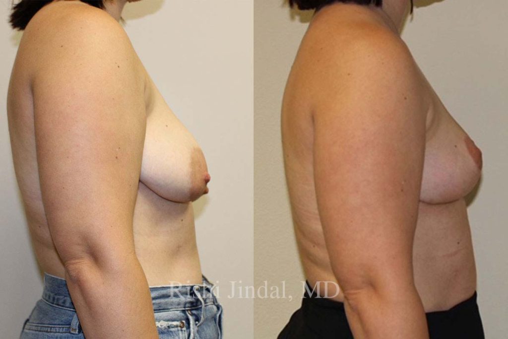 patient-52691a Before and after photos by Dr. Jindal, East County Coastal Plastic Surgeons