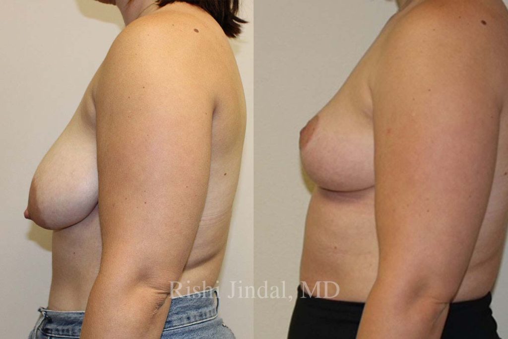 patient-52691c Before and after photos by Dr. Jindal, East County Coastal Plastic Surgeons
