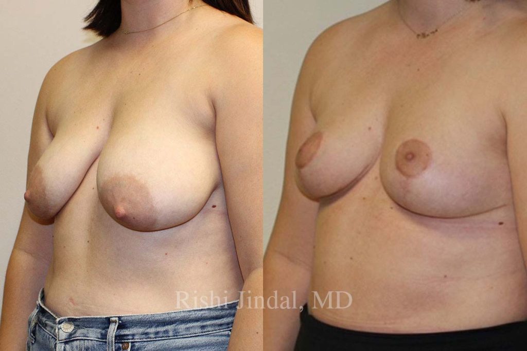 patient-52691d Before and after photos by Dr. Jindal, East County Coastal Plastic Surgeons