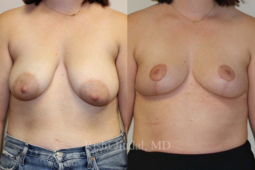 patient-52691e Before and after photos by Dr. Jindal, East County Coastal Plastic Surgeons