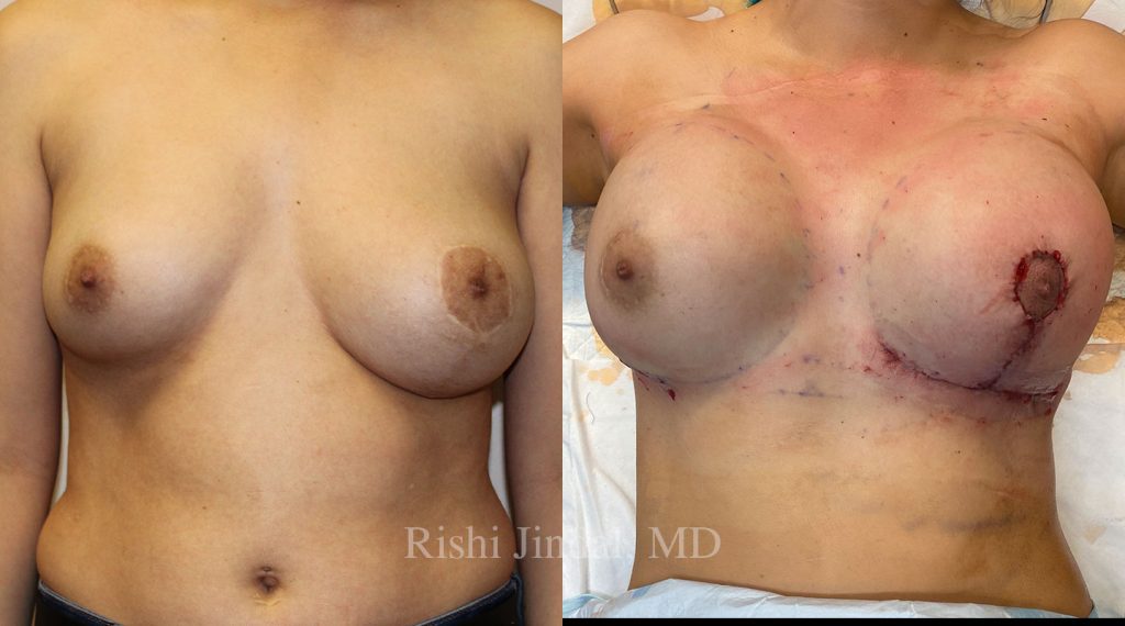 patient-53624a Before and after photos by Dr. Jindal, East County Coastal Plastic Surgeons