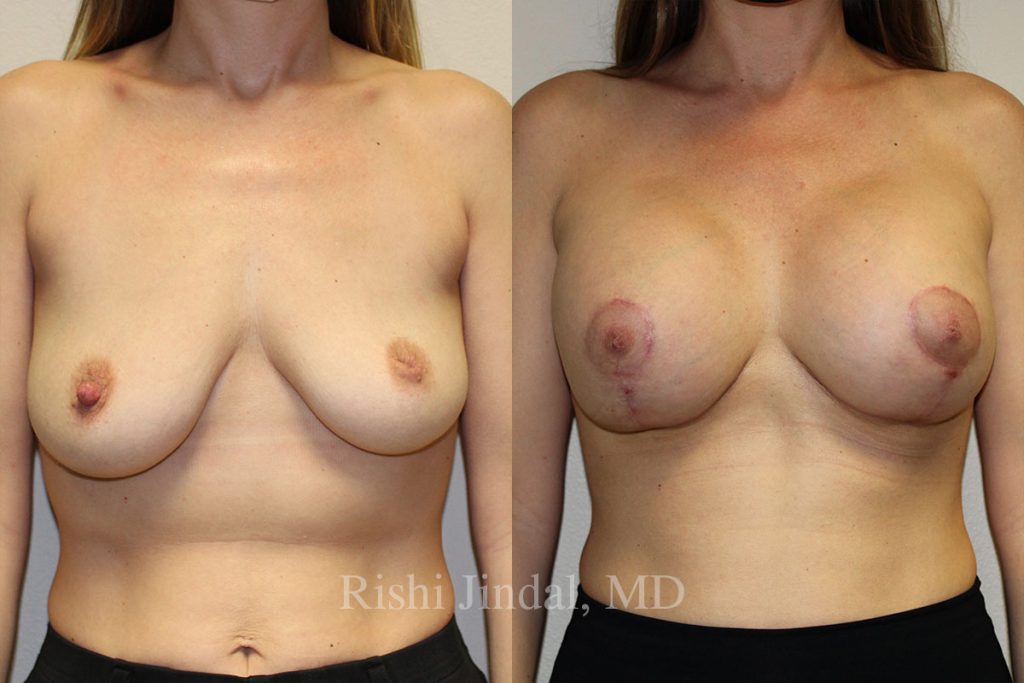 Before and after photos by Dr. Jindal, East County Coastal Plastic Surgeons