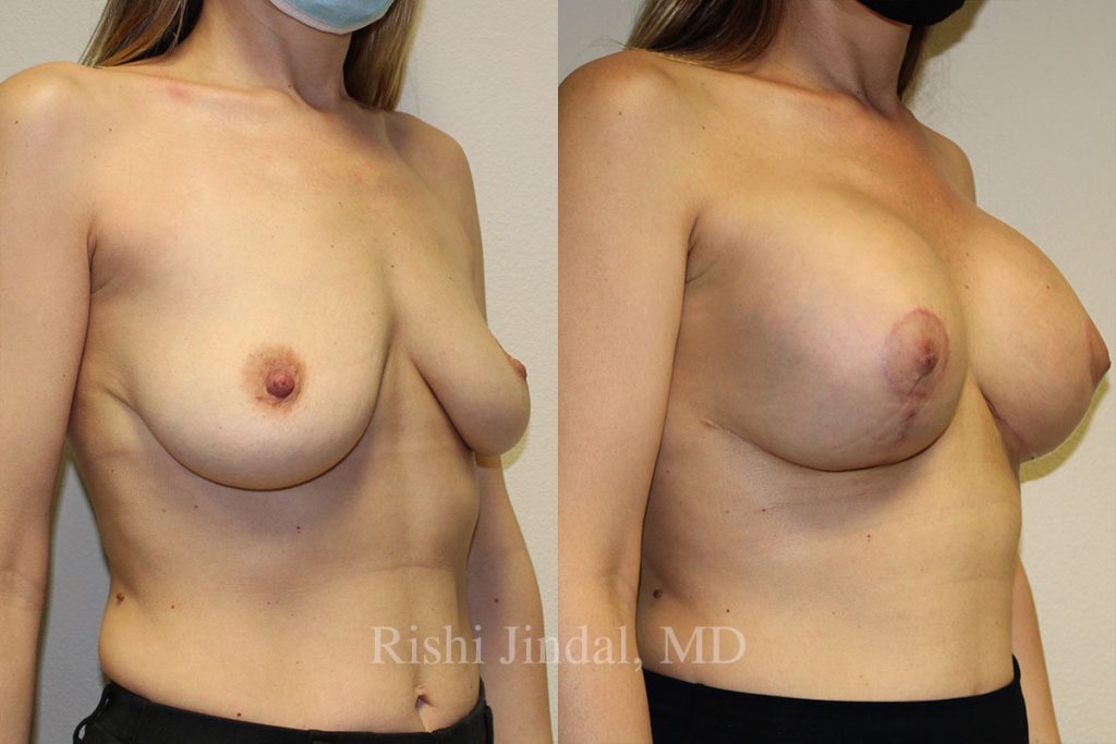 Before and after photos by Dr. Jindal, East County Coastal Plastic Surgeons