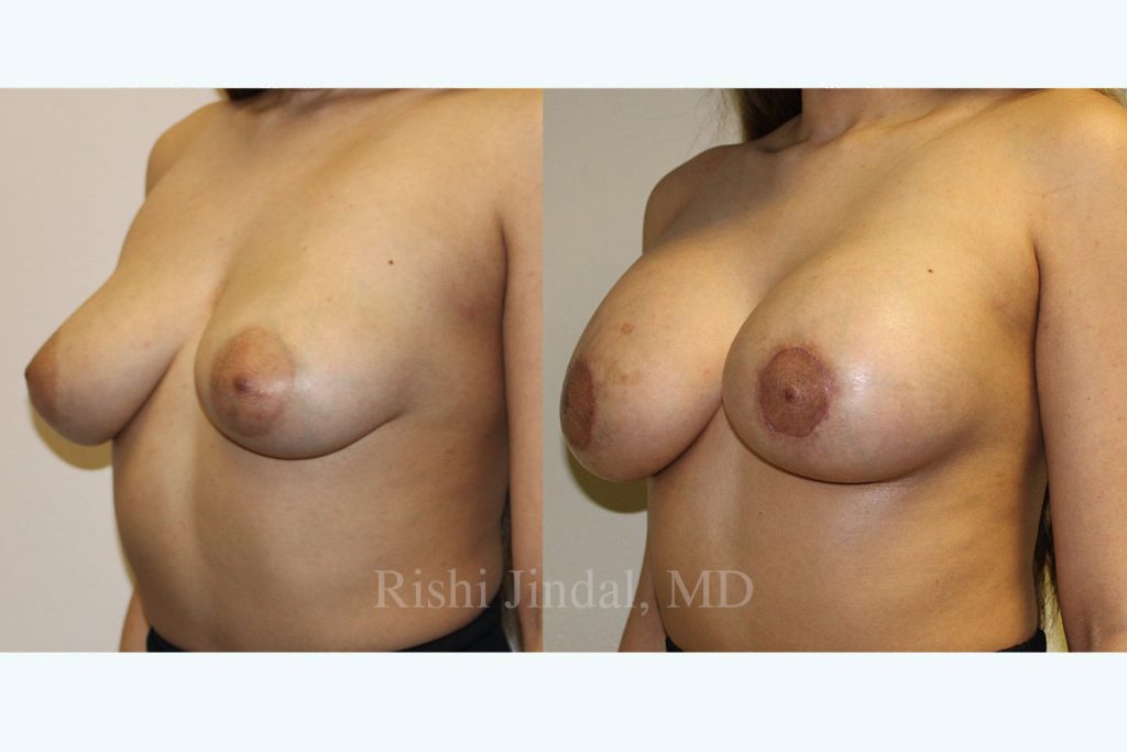 Before and after photos by Dr. Jindal, East County Coastal Plastic Surgeons