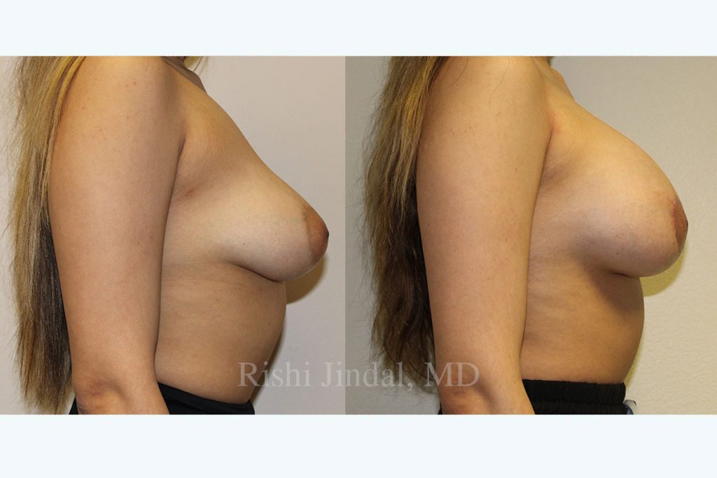 Before and after photos by Dr. Jindal, East County Coastal Plastic Surgeons