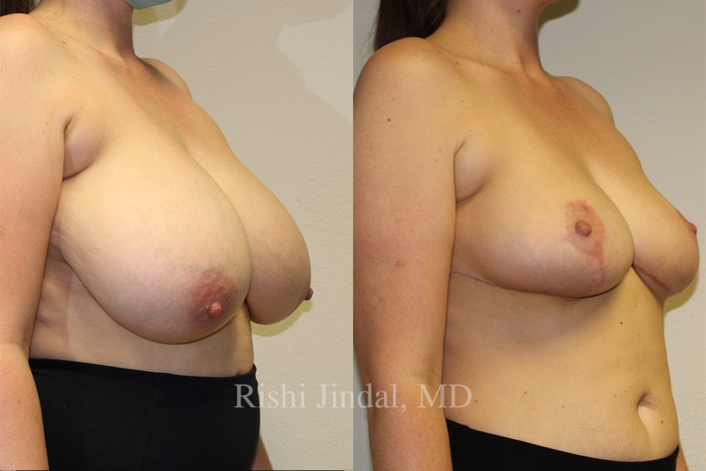 Before and after photos by Dr. Jindal, East County Coastal Plastic Surgeons
