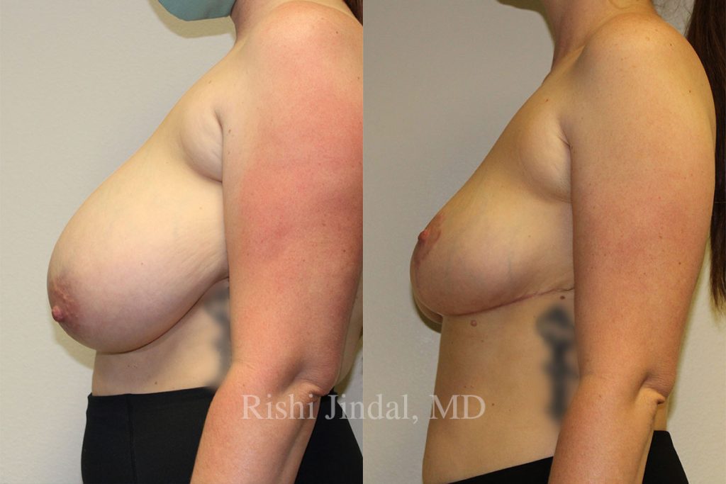 Before and after photos by Dr. Jindal, East County Coastal Plastic Surgeons