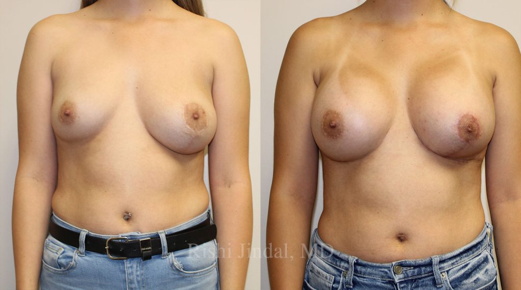 patient-53624-a Before and after photos by Dr. Jindal, East County Coastal Plastic Surgeons