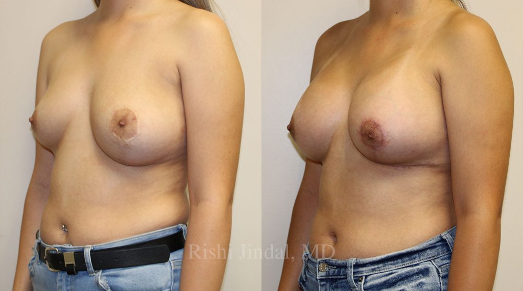 patient-53624-b Before and after photos by Dr. Jindal, East County Coastal Plastic Surgeons