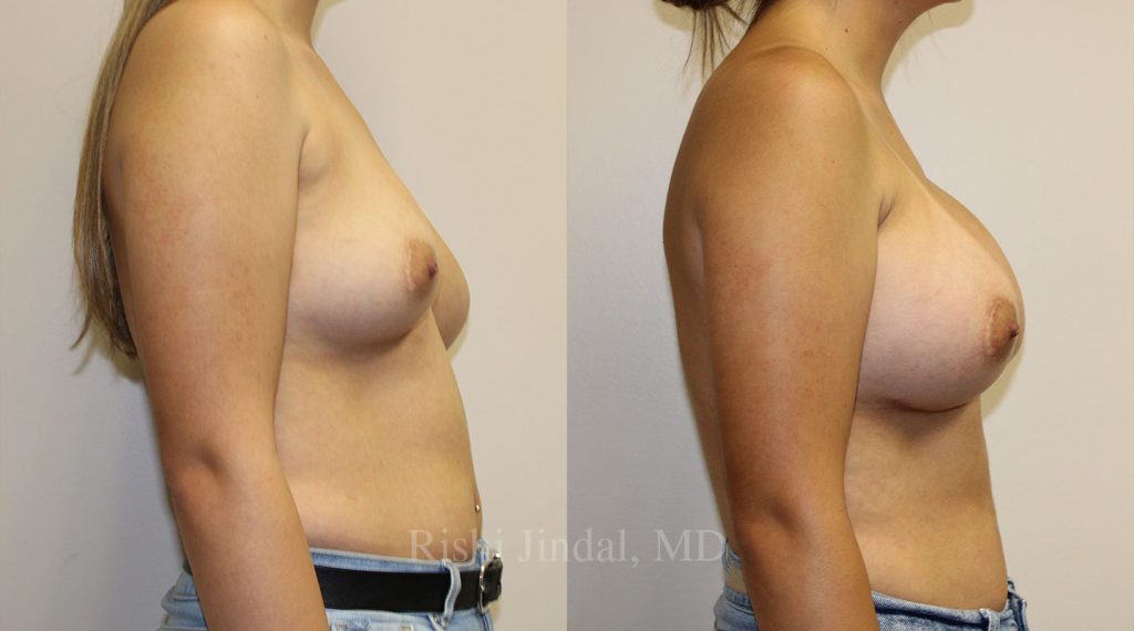 patient-53624c Before and after photos by Dr. Jindal, East County Coastal Plastic Surgeons