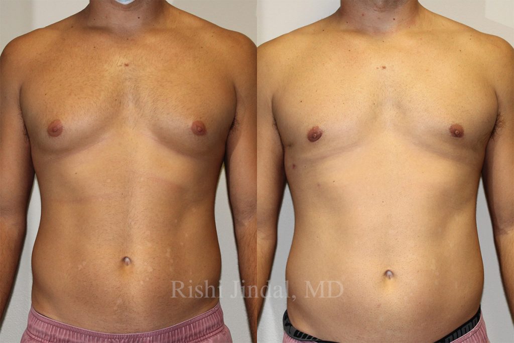 Before and after photos by Dr. Jindal, East County Coastal Plastic Surgeons