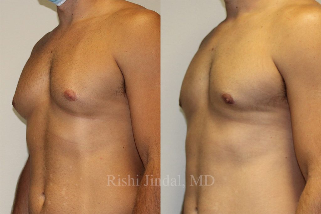 Before and after photos by Dr. Jindal, East County Coastal Plastic Surgeons
