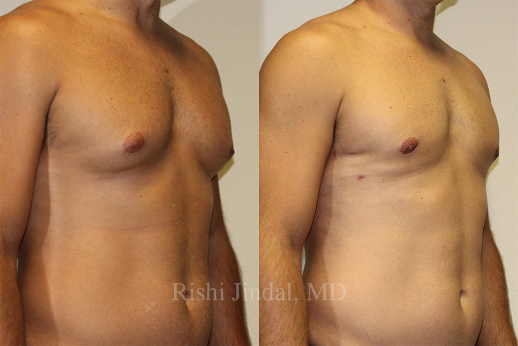 Before and after photos by Dr. Jindal, East County Coastal Plastic Surgeons