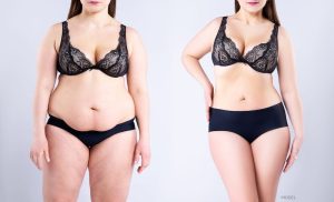 A woman showing before and after weight loss or body contouring.