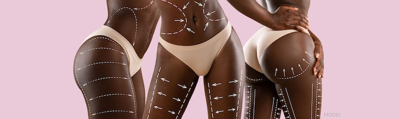 Three female figures with arrows indicating body sculpting treatment.