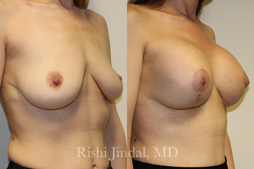 Before and after photos by Dr. Jindal, East County Coastal Plastic Surgeons