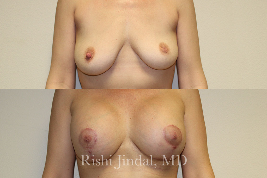 Before and after photos by Dr. Jindal, East County Coastal Plastic Surgeons