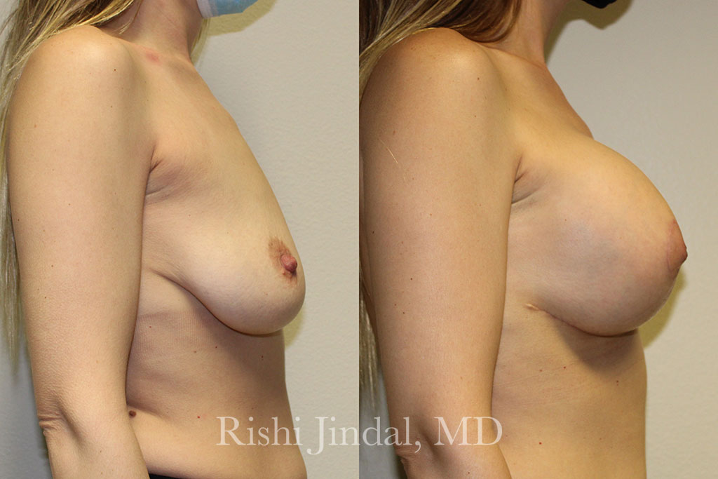 Before and after photos by Dr. Jindal, East County Coastal Plastic Surgeons