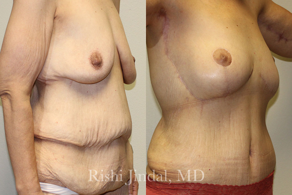 patient-500008b Before and after photos by Dr. Jindal, East County Coastal Plastic Surgeons
