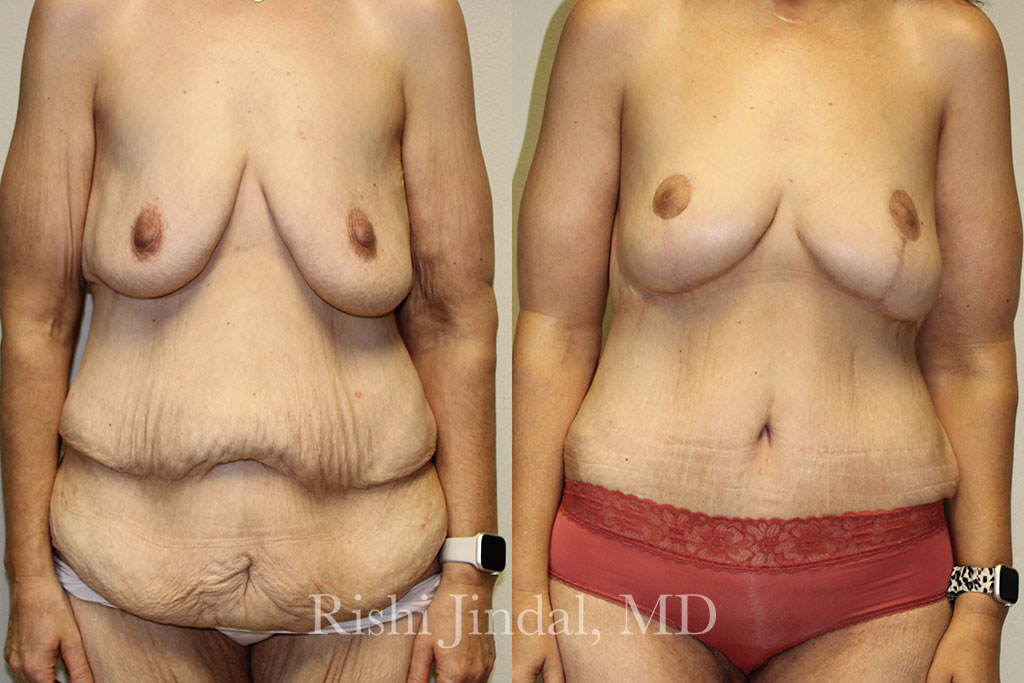patient-50008-bl Before and after photos by Dr. Jindal, East County Coastal Plastic Surgeons