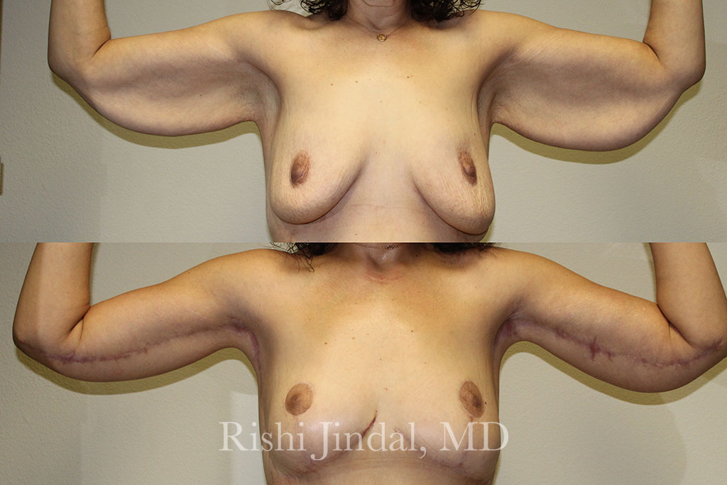 patient-53316a Before and after photos by Dr. Jindal, East County Coastal Plastic Surgeons