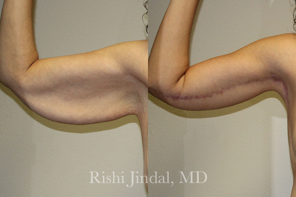 patient-53316b Before and after photos by Dr. Jindal, East County Coastal Plastic Surgeons