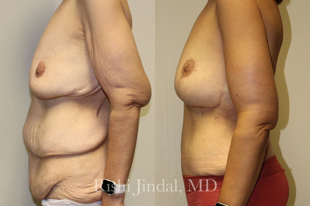 patient-500008b Before and after photos by Dr. Jindal, East County Coastal Plastic Surgeons