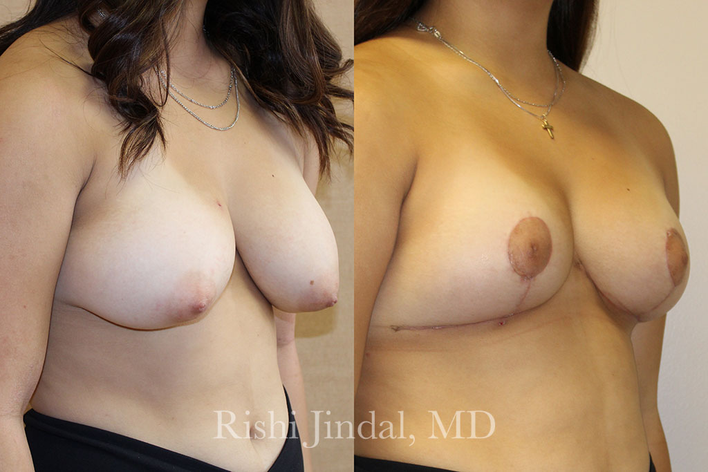 Before and after photos by Dr. Jindal, East County Coastal Plastic Surgeons