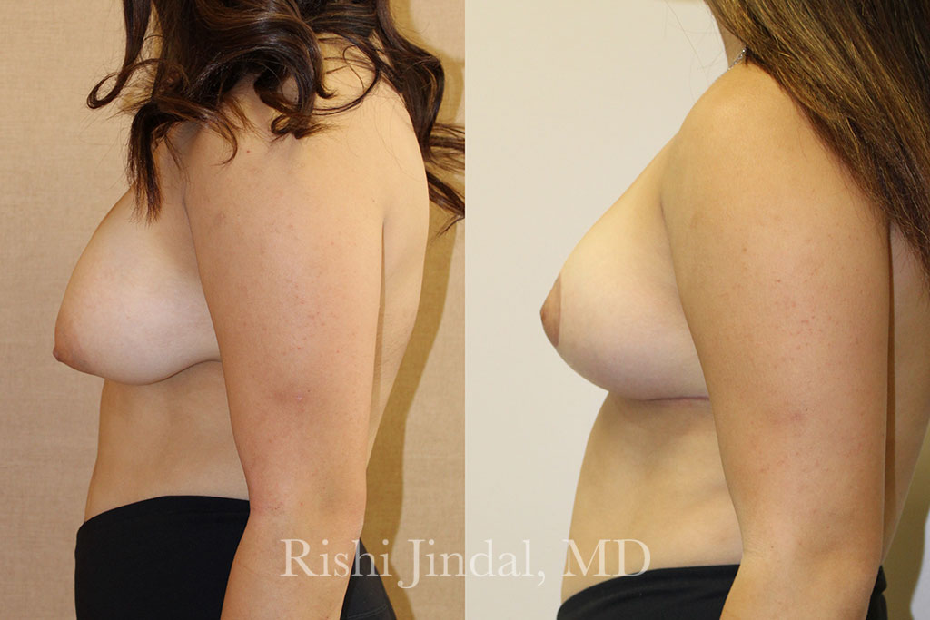 patient-52691d Before and after photos by Dr. Jindal, East County Coastal Plastic Surgeons