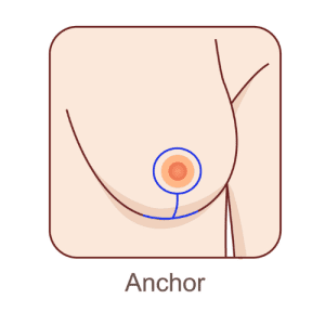 Illustration of anchor technique.